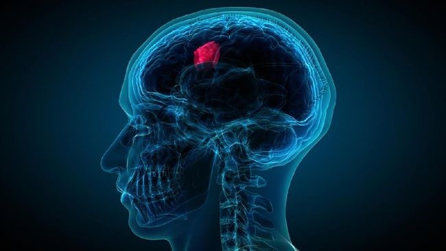 penyebab pembuluh darah di otak pecah