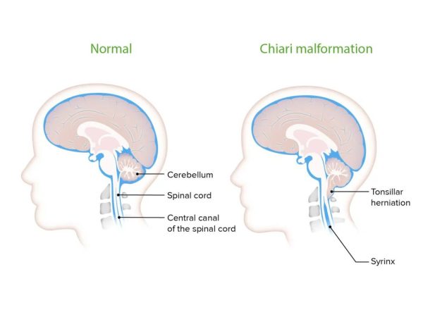 Malformasi Chiari